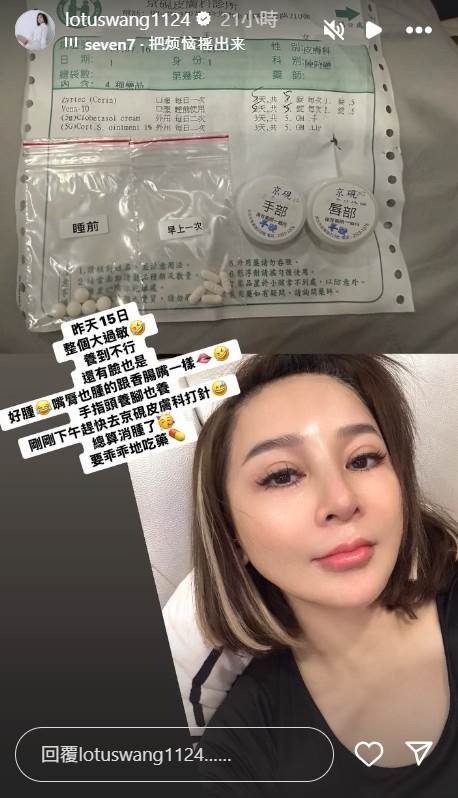 王彩樺透露因為過敏導致臉腫。（圖／翻攝自王彩樺IG）
