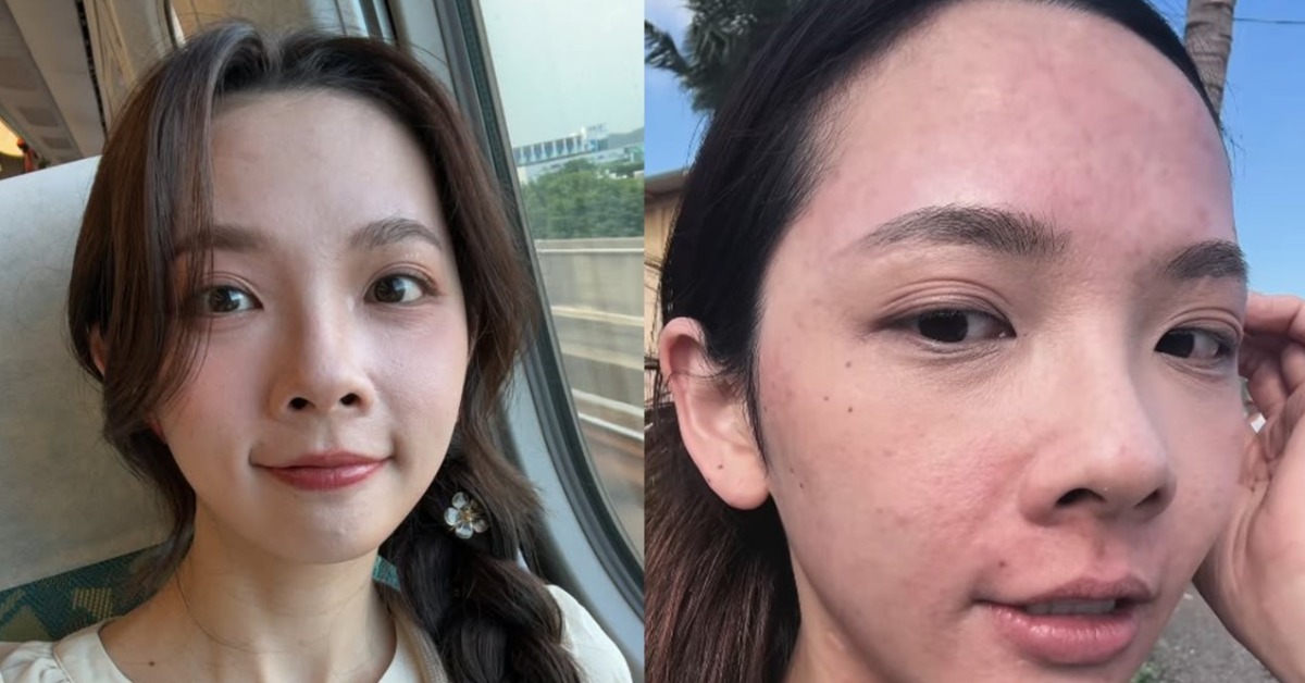 網紅滴妹，最近到夏威夷旅遊，騎馬後整張臉紅腫發癢。（圖／翻攝自滴妹IG）