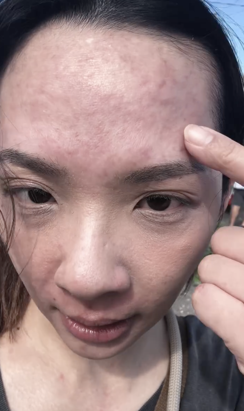 滴妹騎完馬後出現過敏反應。（圖／翻攝自滴妹IG ）