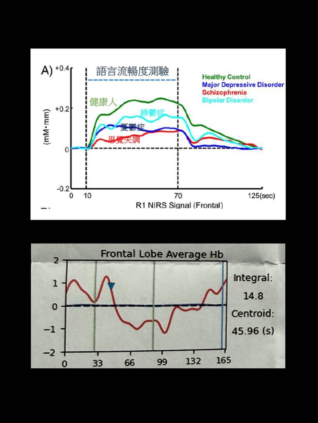 梁云菲接受 NIRS 近紅外線腦血流檢測，藉由「語言流暢度任務」評估前額葉在思考與專注時的活化程度。（圖／翻攝自梁云菲IG）