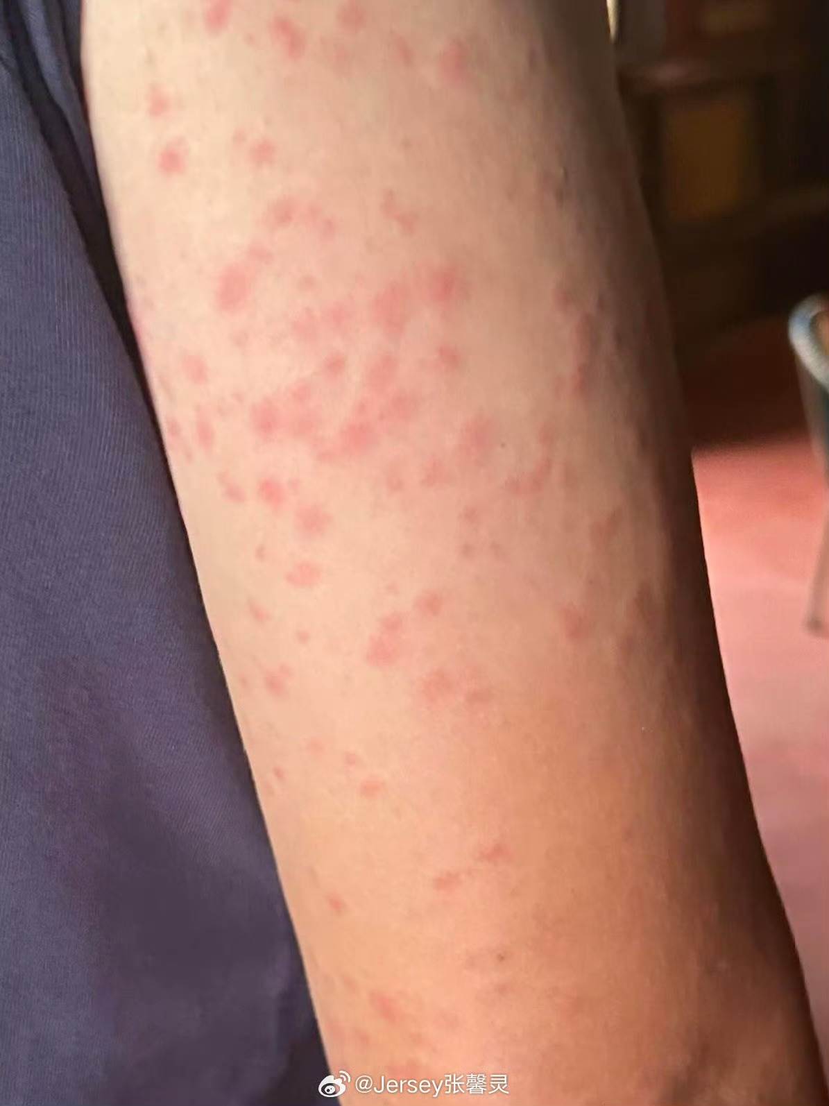 張馨靈也在微博公開她拍攝期間手臂遭蚊蟲叮咬、布滿紅腫包的照片。（圖／翻攝自微博＠Jersey張馨靈）