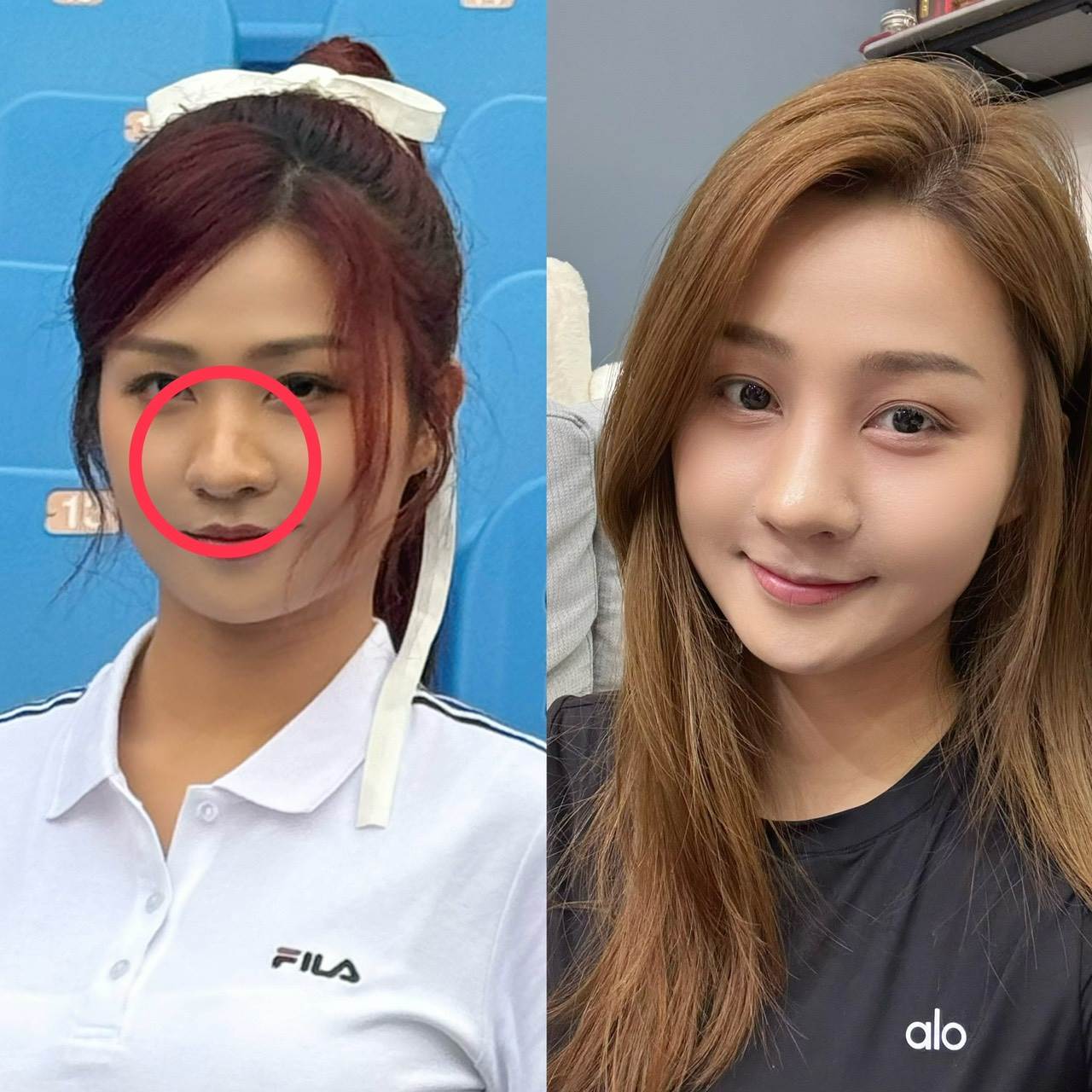 樂天女孩小紫二月拍廣告發現鼻樑變S型，右圖為術後對比。（圖／樂天桃猿提供）