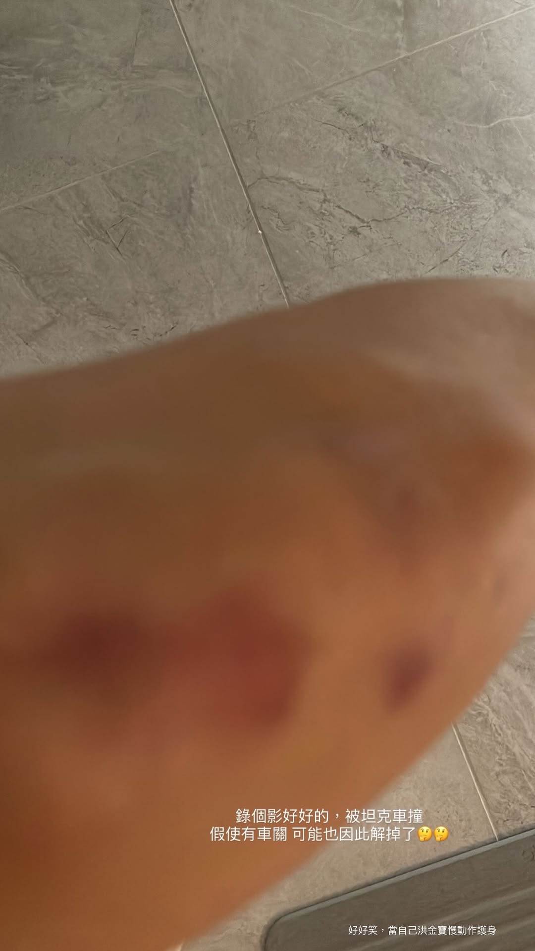 蔡黃汝腳上全是瘀青。（圖／翻攝自蔡黃汝Instagram）