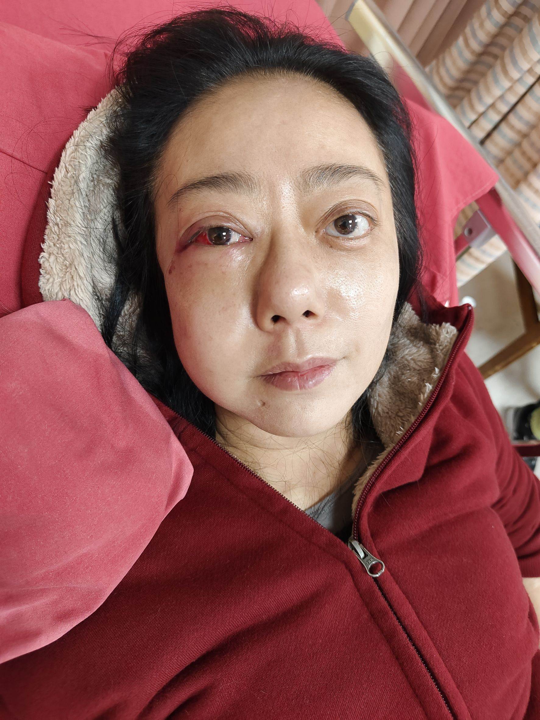 高慧君在家中暈倒導致臉部3處骨折。