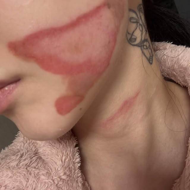 南韓女團AOA前成員權珉娥進行音波拉提療程，卻沒想到雙頰及頸部都遭到深層二度燒傷。（圖／翻攝自權珉娥 IG）