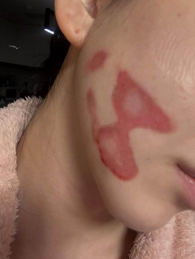 南韓女團AOA前成員權珉娥進行音波拉提療程，卻沒想到雙頰及頸部都遭到深層二度燒傷。（圖／翻攝自權珉娥 IG）