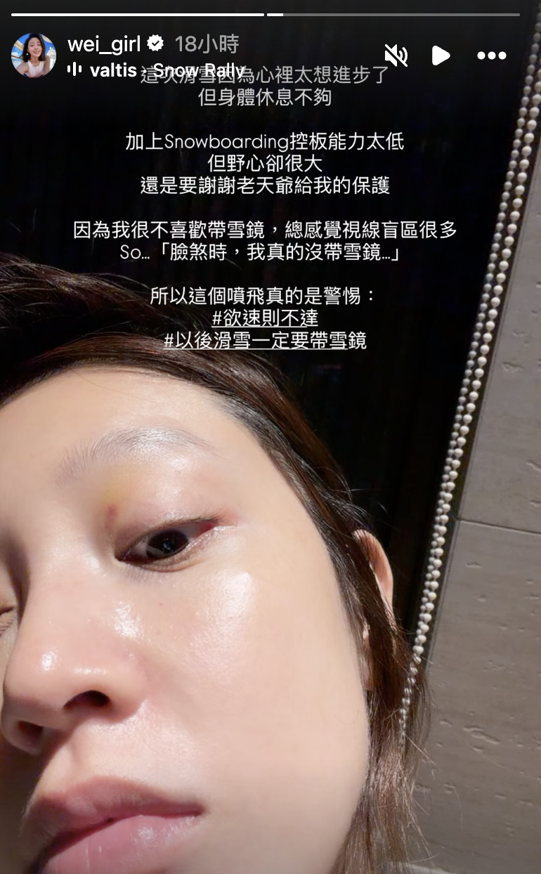 黃薇渟曝光眼皮傷勢。（圖／翻攝自黃薇渟IG）
