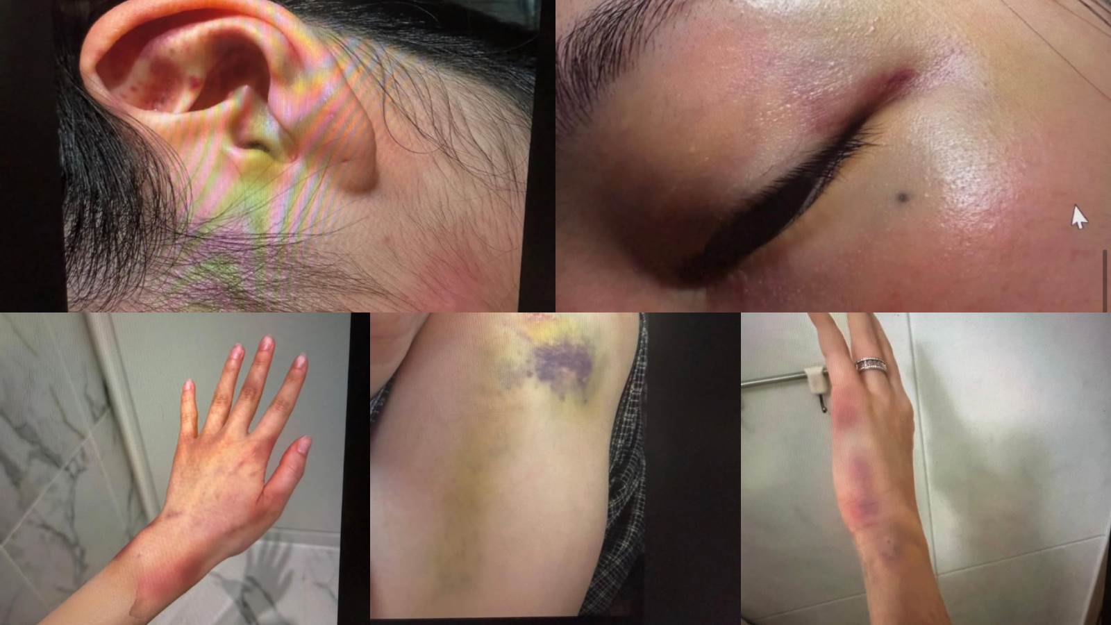 有名自稱是金政勳妻子的網友曬出多張傷照，指控結婚後受到嚴重家暴。（圖／翻攝自Theqoo）