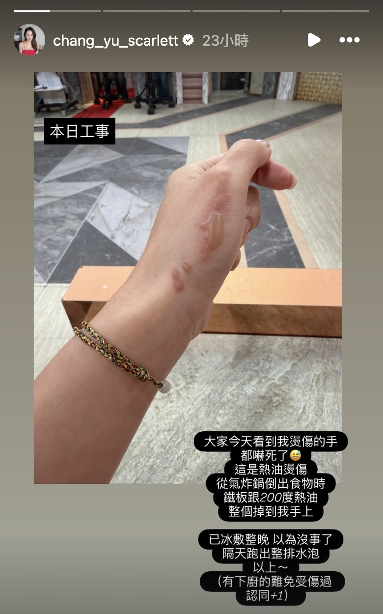 張宇的手被高溫200度的熱油及鐵盤燙傷。（圖／翻攝自張宇IG）