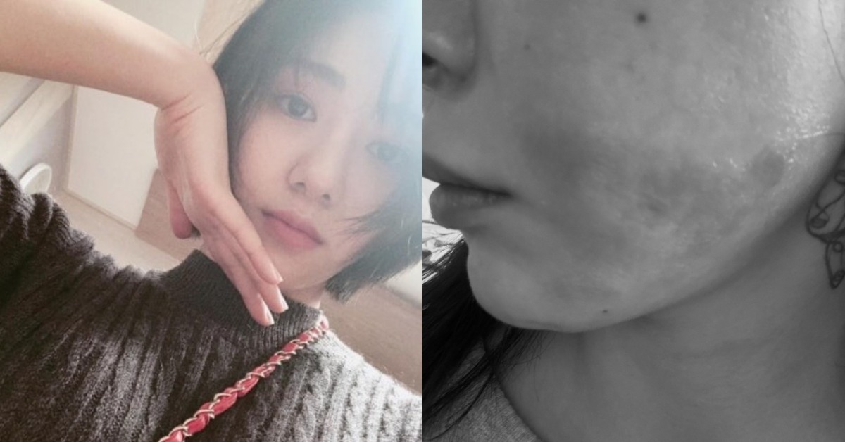 女團AOA前成員權珉娥（권민아）在今年1月進行醫美時，雙頰及頸部卻遭到深層二度燒傷。（圖／翻攝自權珉娥 IG）